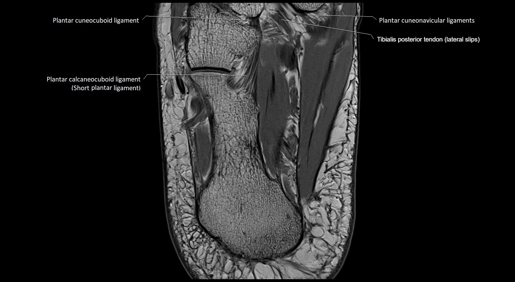 MRI ankle ligaments anatomy axial 3T image 25.webp